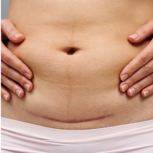C-Section Recovery, C-Section Scar Massage, Horsham, West Sussex