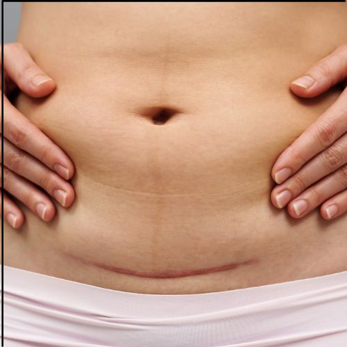 Pelvic Floor Rehab Horsham, West Sussex. Core Rehab Horsham West, Sussex. Core Fitness Horsham, West Sussex. Post-Partum fitness Horsham, West Sussex. Post Natal Fitness, Horsham, West Sussex. Pelvic Health Horsham West Sussex. Incontinence help Horsham, West Sussex. Weak core support post pregnancy, Horsham West Sussex. Diastasis Recti support, Horsham, West Sussex. Prolapse Support, Horsham, West Sussex, Hysterectomy Support, Horsham, West Sussex. Abdominal Separation support, Horsham, West Sussex. C-section Support, Horsham, West Sussex, Caesarean Scar Support, Horsham, West Sussex. C-section Scar massage, Horsham, West Sussex.